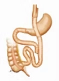 腹腔鏡下ルーワイ胃バイパス術