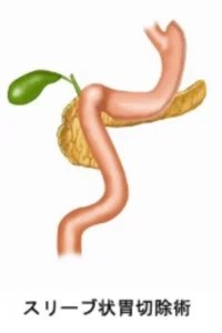 腹腔鏡下スリーブ状胃切除術