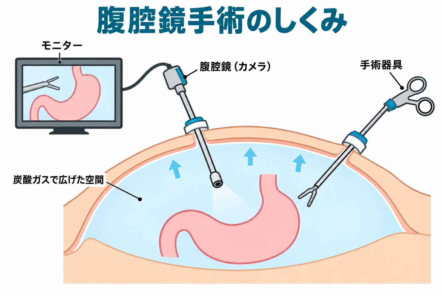 腹腔鏡手術のしくみ