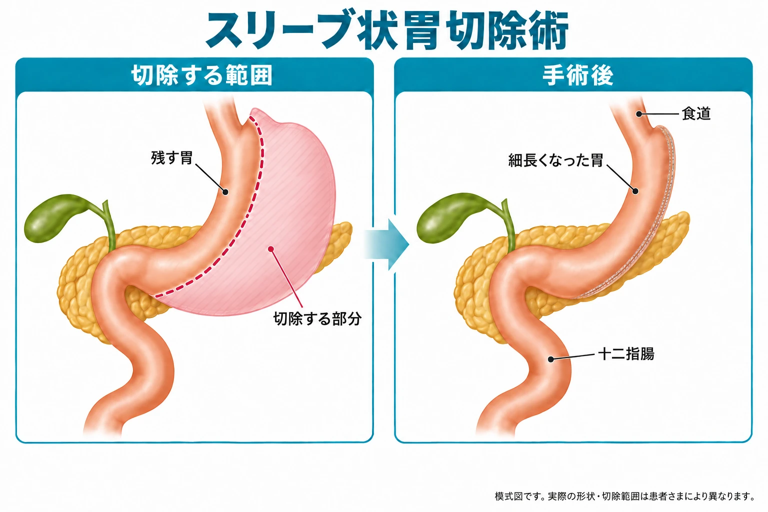 スリーブ状胃切除術の模式図(切除する範囲と手術後の胃)